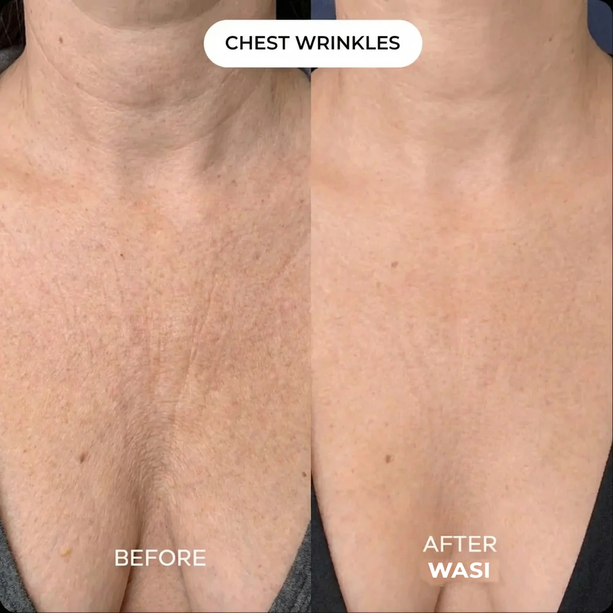 Wasi Collagen Chest Mask - chest wrinkles before and after